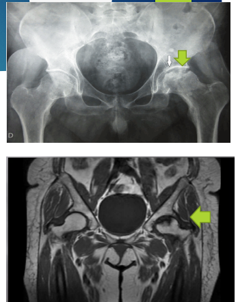 <p><strong>AVN: S/S, Diagnosis, and Treatment</strong></p><p>-S/S</p><ul><li><p>____, aching, ______ pain </p></li><li><p>Pain with weight bearing = _______ gait</p></li><li><p>Pain with hip ROM = ____________ ROM</p></li></ul><p>-Diagnosis</p><ul><li><p>_____ is the initial imaging of choice (mild density changes → sclerosis/cysts) </p></li><li><p>MRI → ________ sign</p></li></ul><p>-Treatment</p><ul><li><p>Refer to ______</p></li></ul><p></p>