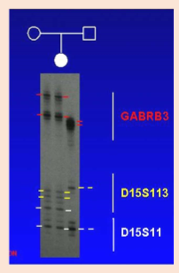 <p>Absence of paternal alleles</p><p>maternal UPD also confirmed by inheritance of both copies of maternal 15 in child</p>