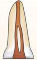 <p><span><span>(2-1)</span></span></p><p><span>Two separate canals leave the pulp chamber and join short of the apex to form one canal </span></p>