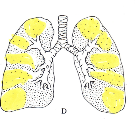 <p>Diagnosis?</p><p>Ventilation study ABNORMAL</p>