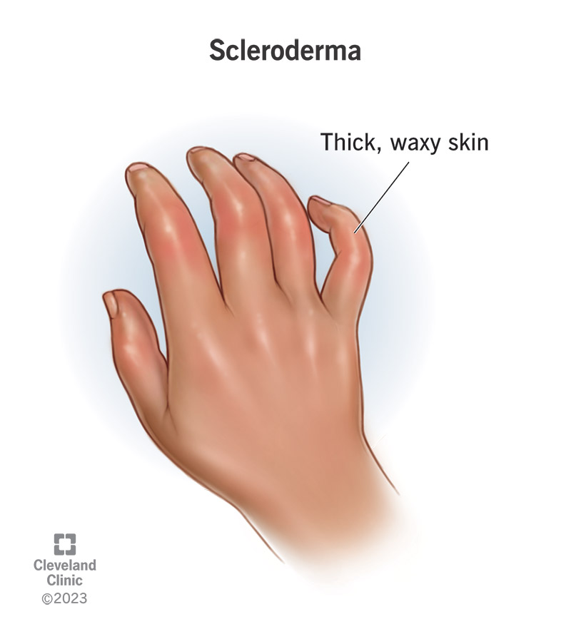 <p>Disease causing skin and connective tissue hardening.</p>