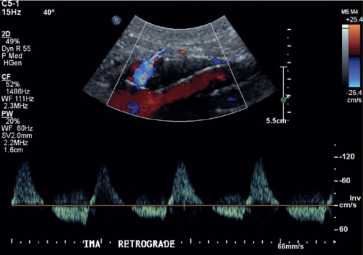 <p>Leaks from branching vessel of aorta (IMA, renal A, lumbar A)</p><p>Spectral can be bidirectional, monophasic, multiphasic, slow or high flow</p>