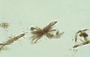 Tyrosine crystals in rosette forms