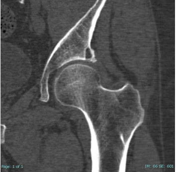 <p><strong>Interpreting a CT</strong></p><p>-Know your anatomy</p><p>-Identify the plane:</p><ul><li><p>____ → looking through the body from the inferior aspect to the superior (horizontal slice)</p></li><li><p>_______ → looking across the body from front to back</p></li><li><p>_________ → looking across the body from right to left or left to right </p></li></ul><p>-Shades of white, gray, and black </p><ul><li><p>Dense structures (bone) = _____</p></li><li><p>Fat/fluid = varying levels of ____</p></li><li><p>Air = _____</p></li></ul><p></p>