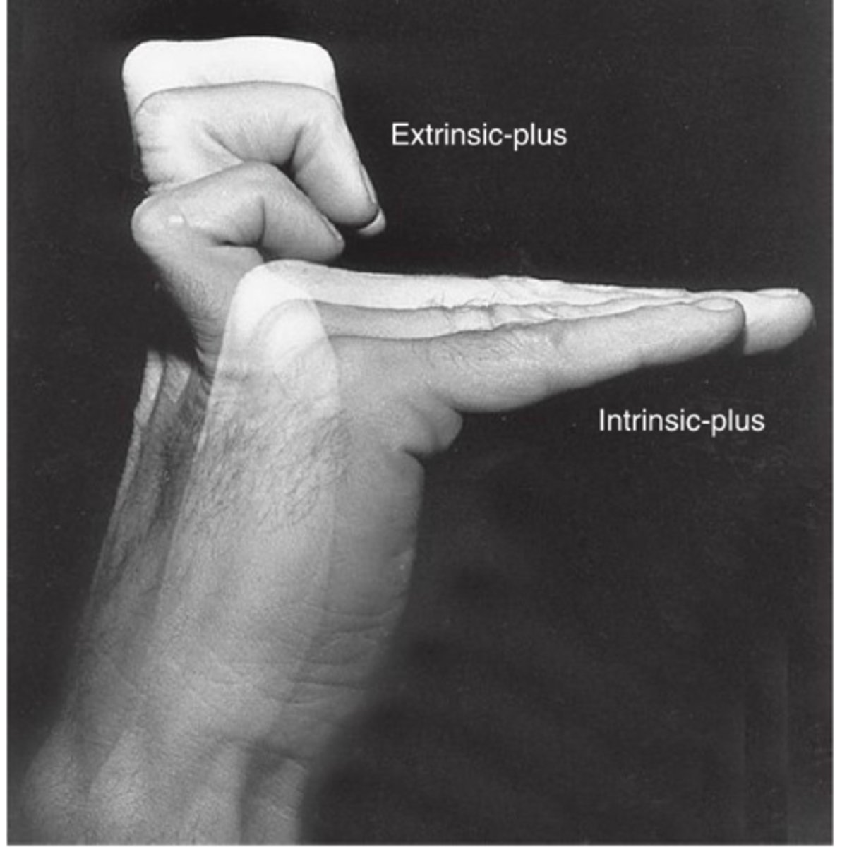 <p>1. What puts the hand in an extrinsic plus (Intrinsic Minus) position?</p><p>2. If only the pinky and ring finger were in the claw position, what nerve is affected?</p>