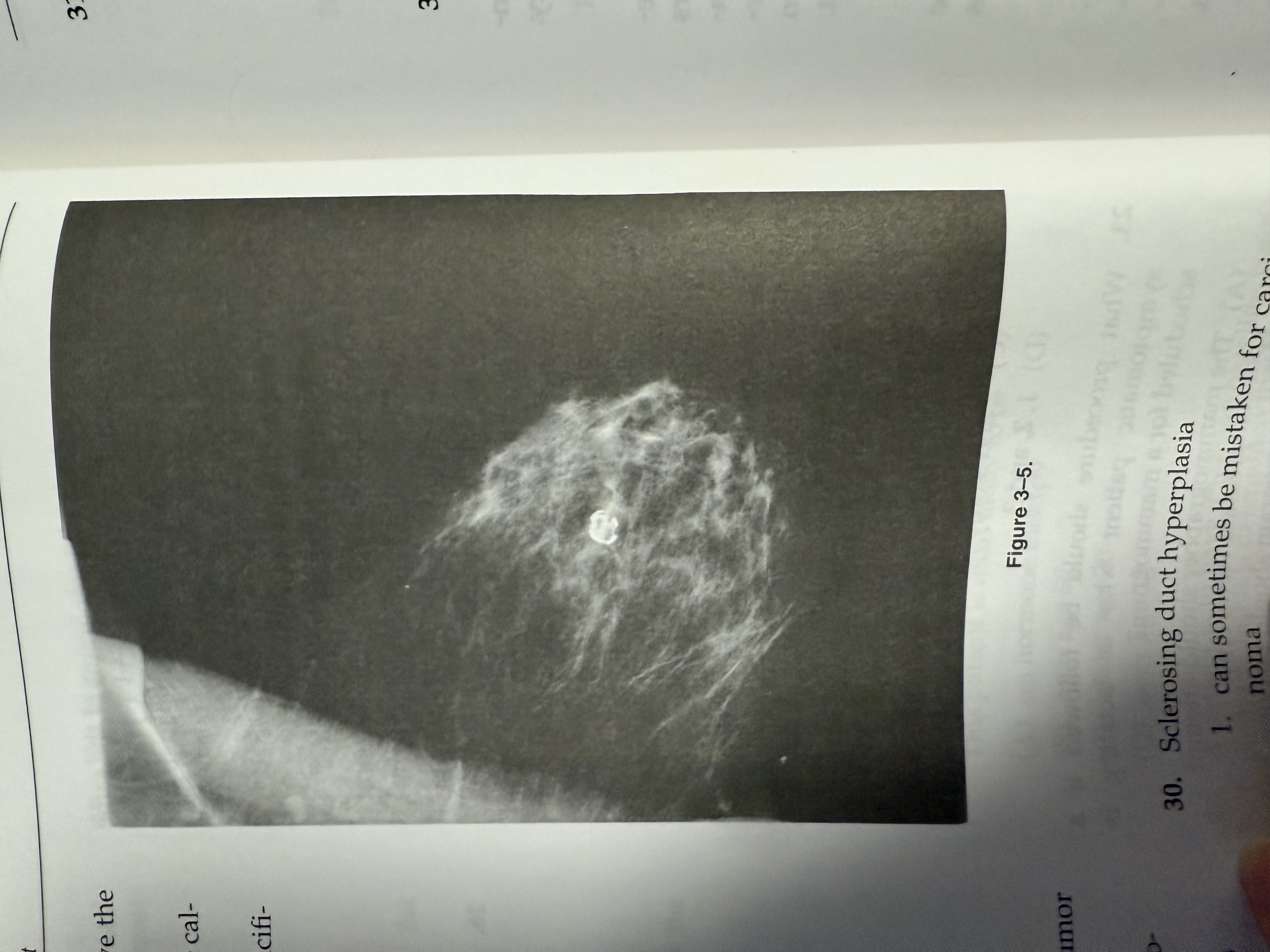 <p><span>The calcifications seen in Figure 3-5 have the typical appearance of</span></p><ol><li><p><span>﻿﻿﻿﻿an oil cyst</span></p></li><li><p><span>﻿﻿﻿﻿plasma cell mastitis calcification</span></p></li><li><p><span>﻿﻿﻿﻿a small hematoma</span></p></li><li><p><span>﻿﻿﻿﻿a calcified sebaceous gland</span></p></li></ol>