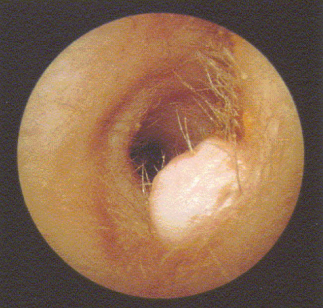 <p><u>disordered otoscopy: canal</u></p><p>fibroma</p>