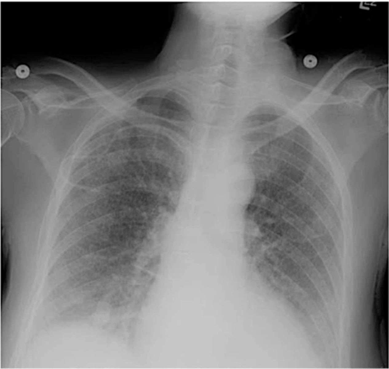 <p>-diffuse patchy inflammation in interstitial areas of alveolar walls (concentrated in perihilar area)</p>
