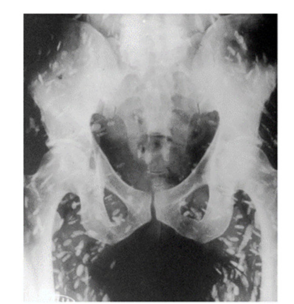 <p>The intermediate host of Taenia solium is the pig but can use the human as an intermediate host. The genus and species name for the metacestode stage of this parasite is</p>