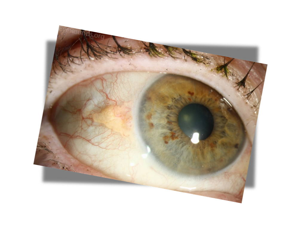 <p>yellow bump/growth on conjunctiva of eye, rarely grows (does not cross into cornea )</p>