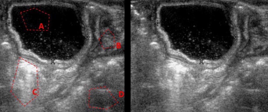 <p>State the ultrasound phenomena in the indicated area (specular reflection, transmission, scattering, enhancement, shadowing)</p>