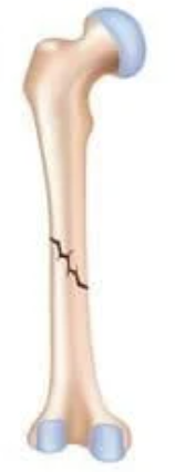 <p><strong><mark>a bone break that occurs at an angle, often in long bones like the femur, tibia, or fibula</mark></strong><span style="font-family: Google Sans, Roboto, Arial, sans-serif">.</span></p>