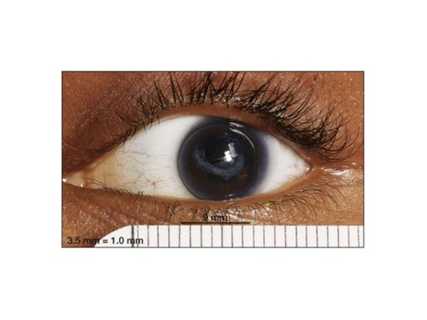 <p>small cornea</p>