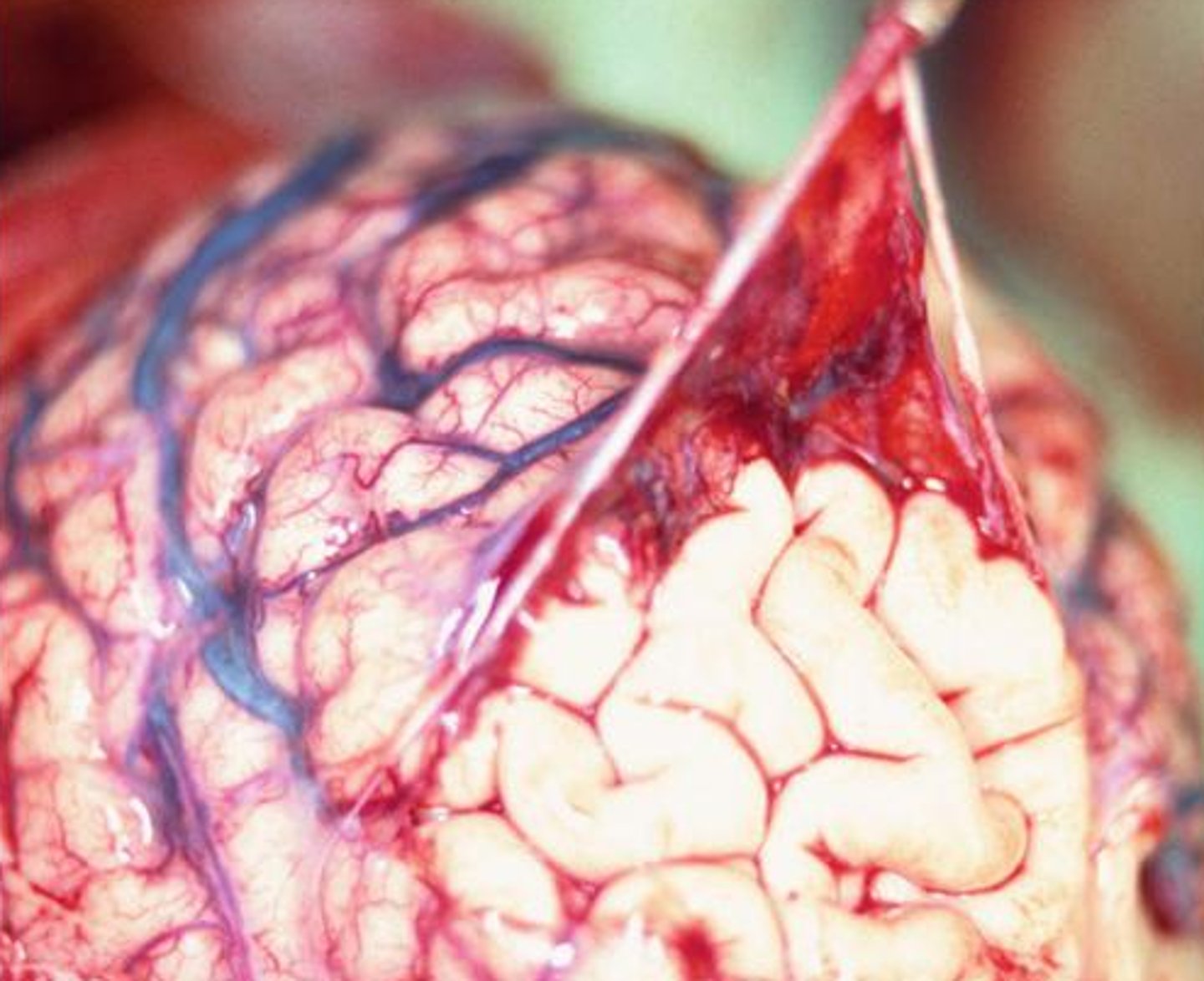 <p>Middle, web-like meningeal layer containing cerebrospinal fluid.</p>