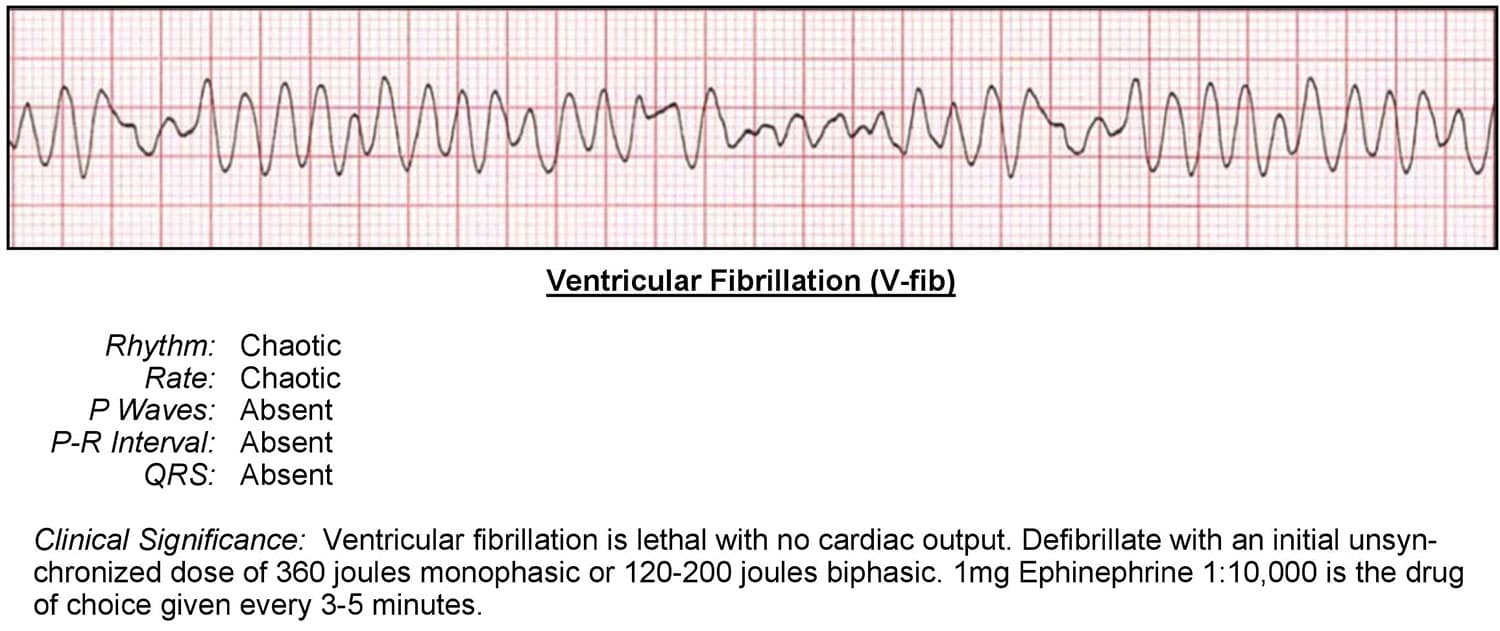 <p>v fib</p>