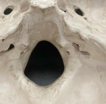 <p>Large opening in occipital bone</p>