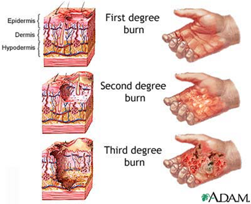 <p><span>- full thickness (epidermis, dermis, hypodermis, into muscle and bone)</span><br><span>- tissue appears gray-ish, charred, cherry red</span><br><span>- initially little to no swelling (edema) or pain (destruction of nerve endings)</span><br><span>- high risk of infection, scarring is common</span><br><span>- takes longest to heal</span><br><span>- usually requires skin grafts</span></p>