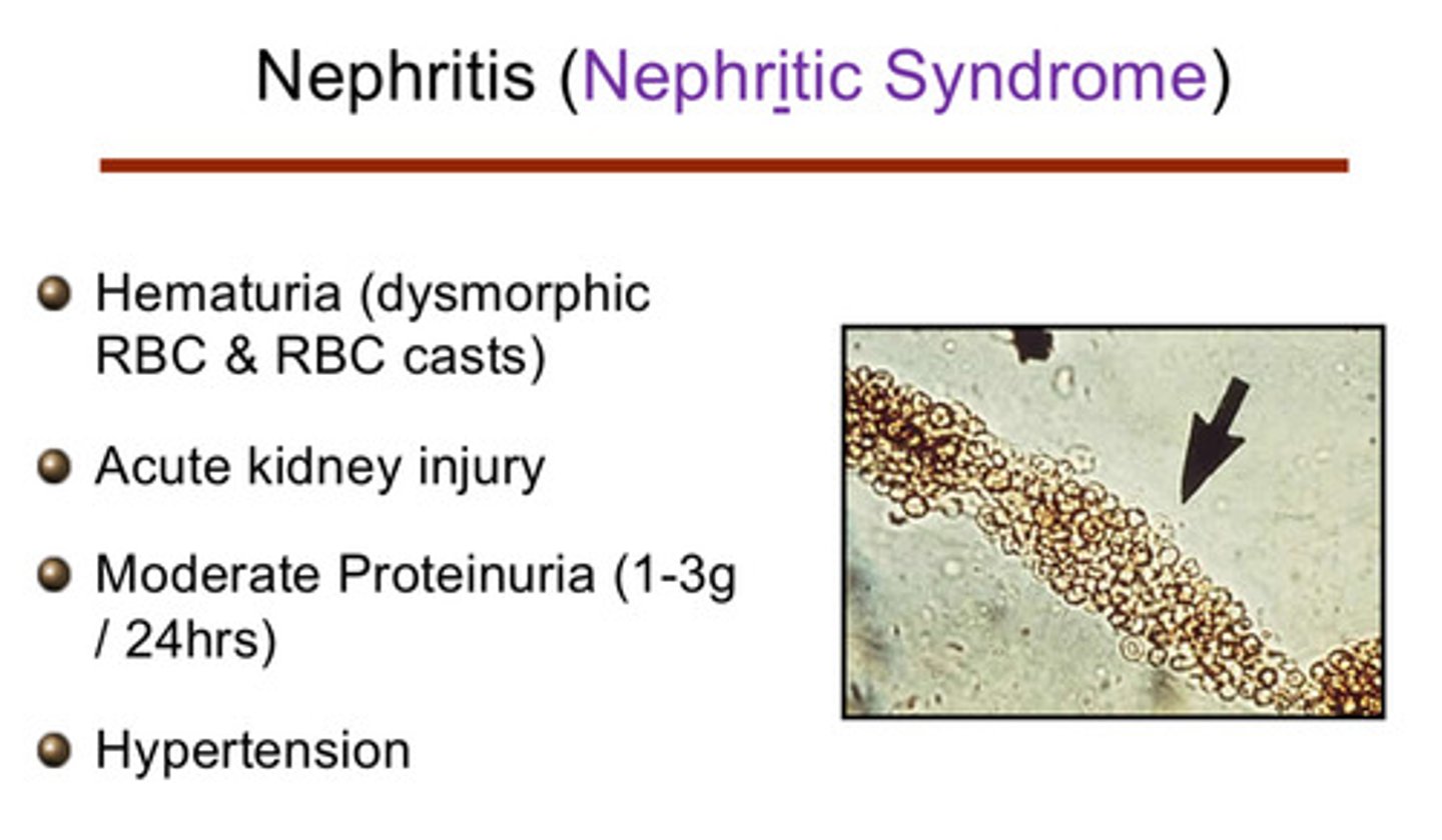 <p>1) hematuria (dysmorphic RBC and RBC casts)</p><p>2) acute kidney injury</p><p>3) moderate proteinuria (1-3 g/24 hours)</p><p>4) hypertension</p>