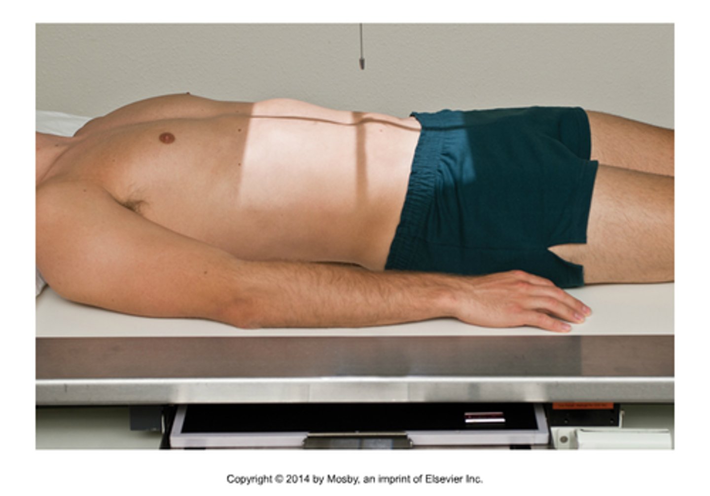 <p>perpendicular to iliac crest (L4)</p>