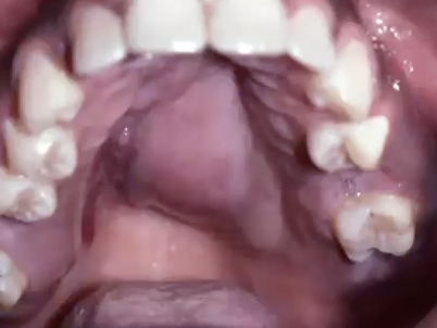 <p>How would you treat Adenoid cystic carcinoma?</p>