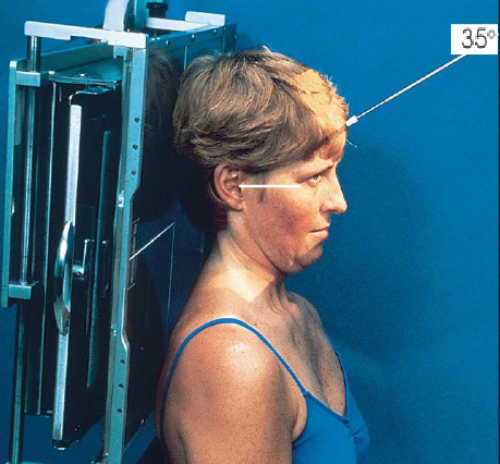 <ul><li><p>patient position:</p><ul><li><p>supine or upright</p></li><li><p>posterior skull in contact with Bucky/table</p></li></ul></li><li><p>part position:</p><ul><li><p>MSP of head perpendicular</p></li><li><p>flex neck to place OML perpendicular to IR</p></li><li><p>one exposure taken with mouth closed</p></li><li><p>one exposure taken with mouth open, if not contraindicated</p></li></ul></li><li><p>respiration suspended</p></li><li><p>CR:</p><ul><li><p>35 degrees caudad</p></li><li><p>midway between TMJs, 3 inches above nasion</p></li></ul></li><li><p>collimation:</p><ul><li><p>1 inch beyond the lateral sides, superiorly to the glabella, and inferiorly to the lips</p></li></ul></li></ul><p></p>
