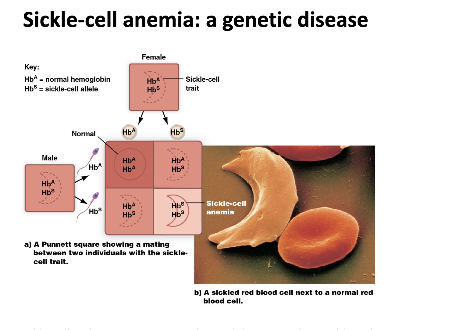 <p>Sickle cell is the mist common INHERITED DISEASE in the world with 400,000 infants a year born with the disease</p>