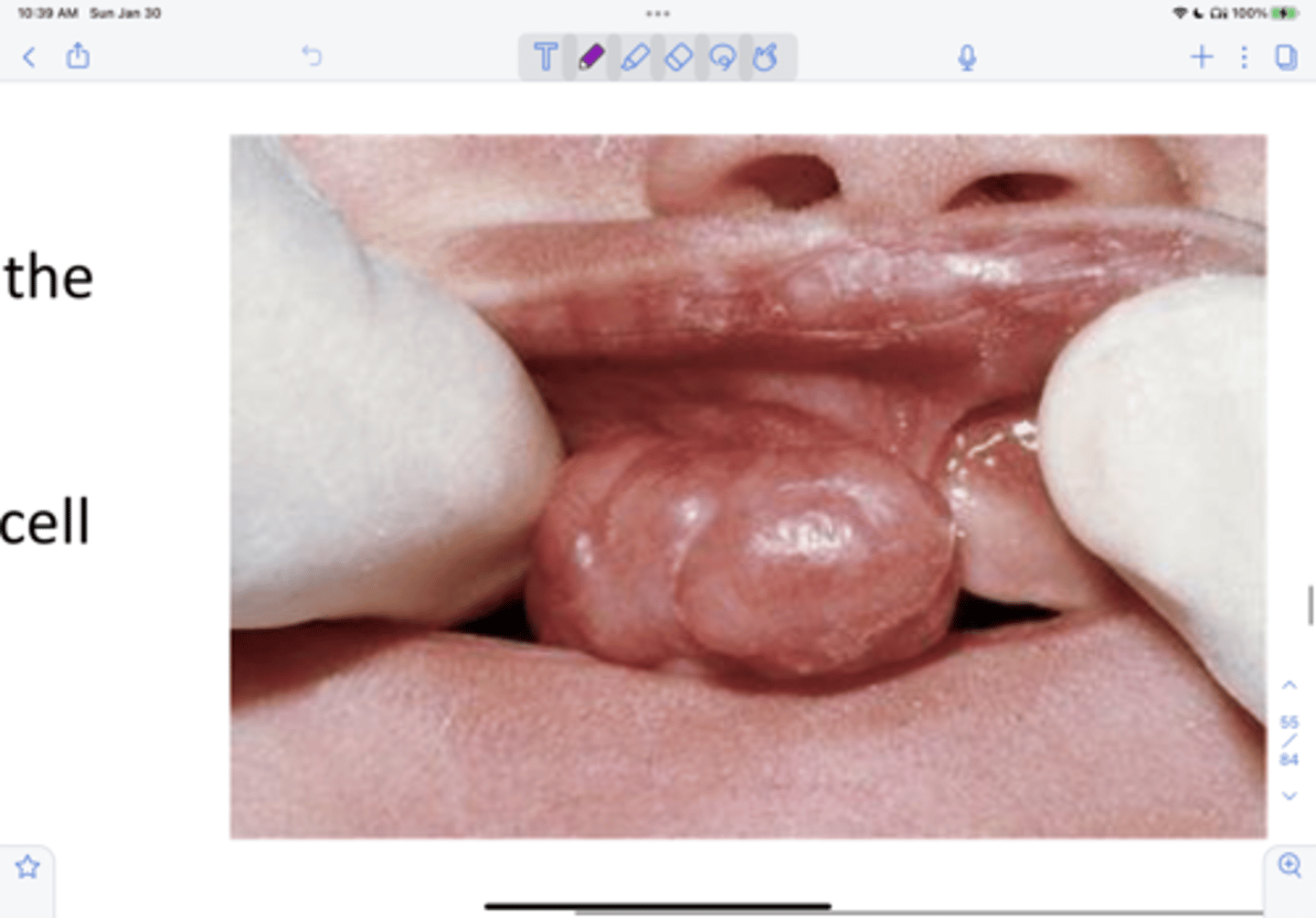 <p>____ ___ is uncommon, occurs almost exclusively on the alveolar ridges of newborns, bears a microscopic resemblance to the granular cell tumor. It appears clinically pink-red, smooth-surfaced, polypoid mass on the alveolar ridge of a newborn, more common in maxilla and 90% occurs in female. It can be surgical excised with submission for histopathologic examination, no reports of recurrence, ever.</p>