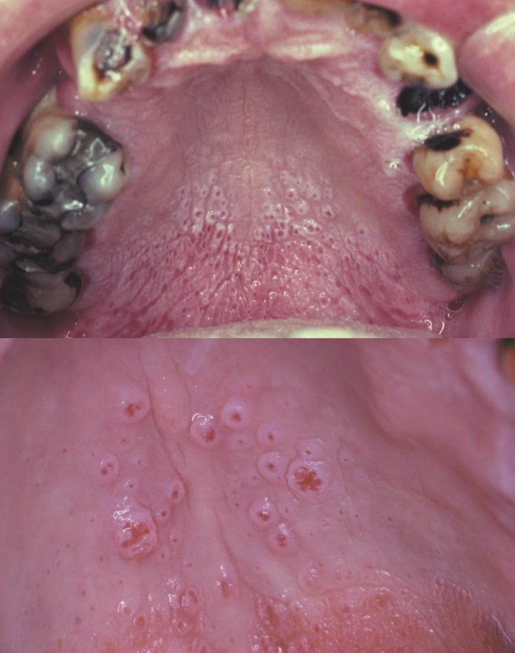 <p>which environmental/reactive lesion: prominent salivary ducts from heat </p>
