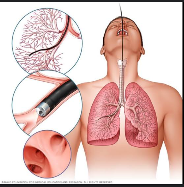<p>It is used to visualize the tracheobronchial tree. A flexible bronchoscope is introduced into the tracheobronchial tree through the nose, mouth, or endotracheal or tracheotomy tube. Samples of fluid and tissue may be obtained for Gram staining, culture, and cytologic examination</p>