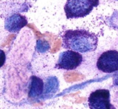 <p>- heparin, histamine, proteases, preformed TNF-alpha</p><p>- vasodilation, vascular leakage, smooth muscle constriction </p>