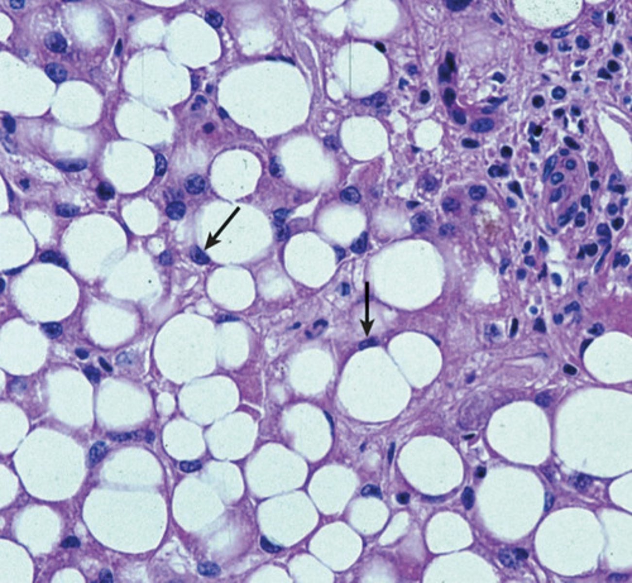 <p>What cellular accumulation is occurring in this image?</p>