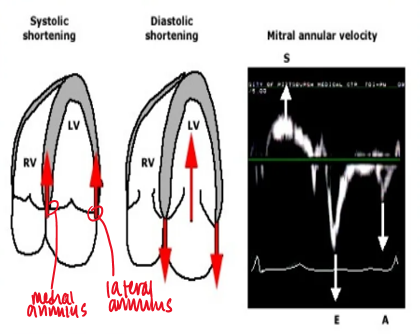<p>above : how far annulus moves away from apex (diastole) </p><p>below : how far annulus moves towarsd apex (systole) </p>
