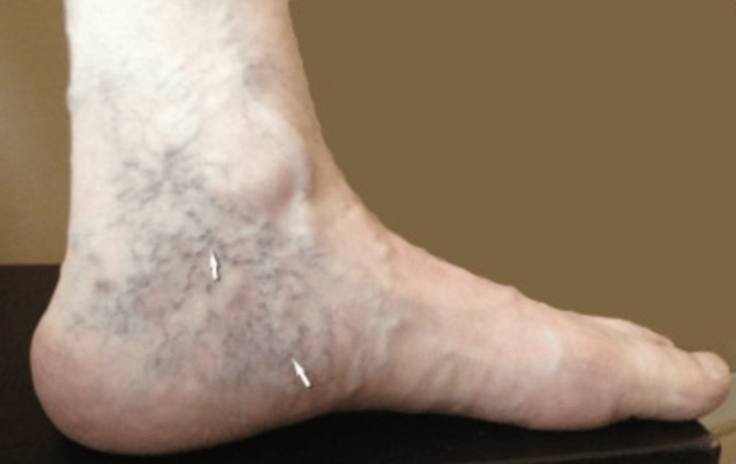 <p>Discoloration from grouping of spider veins</p>