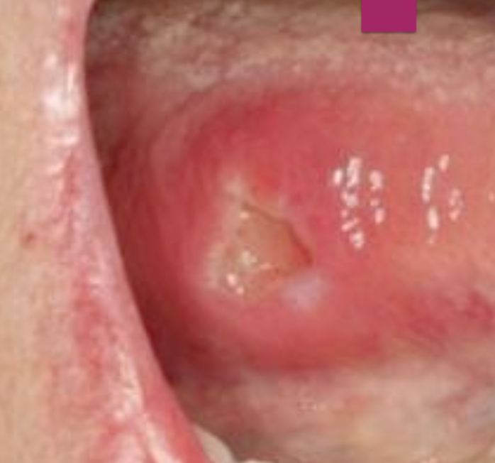 <p>What does Traumatic Ulcerative Granuloma with Stromal Eosinophilia (TUGSE) look similar to?</p>