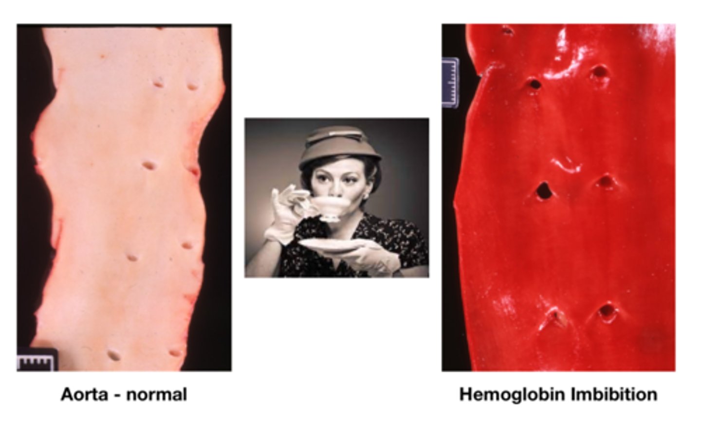 <p>- Red staining of tissues due to RBC lysis and hemoglobin breakdown</p>