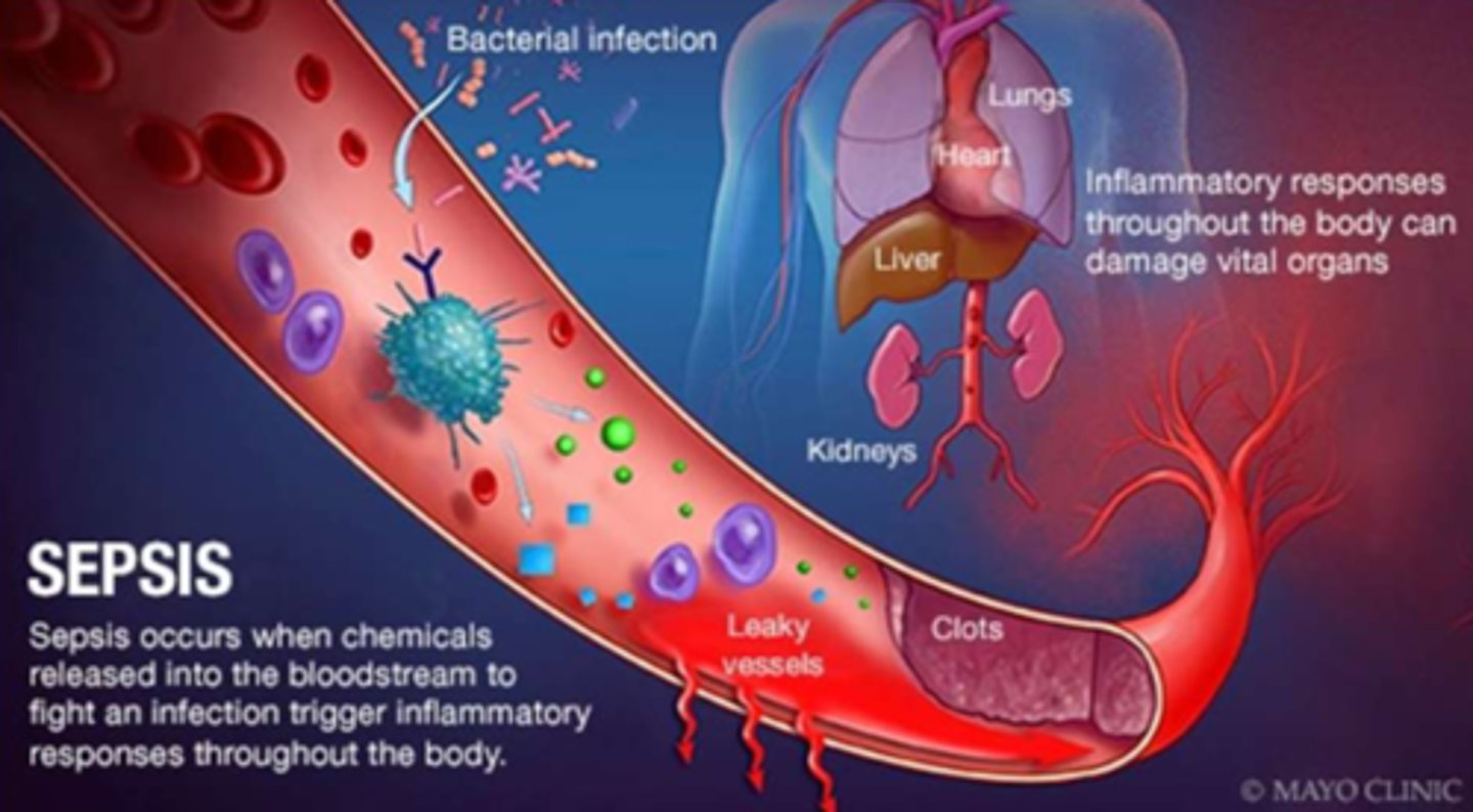 <p>- 'infection from ANY body part that causes an extreme inflammatory response &amp; organ hypoperfusion => life threatening'</p><p>- infection is in: blood (septicemia/bacteremia) OR in tissue (within an organ)</p><p>- hypoperfusion: d/t vasodilation (systemic inflammation)</p><p>- ALWAYS an emergency, progresses to septic shock if untreated</p><p>- not 'staged'</p><p>- tx as per protocol, if hypoperfusion persists: septic shock dx</p>