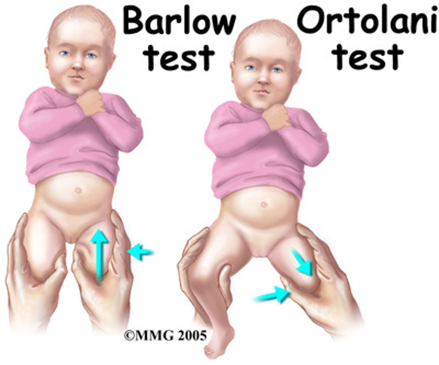 <p>Place the thumb on the newborn's inner thigh and index finger over the greater trochanter.</p><p>With the knees flexed 90 degrees, abduct the upper leg applying gentle pressure on the trochanter.</p><p>A positive test indicate possible DDH is noted by a CLUNK or JERK with this maneuver.</p>