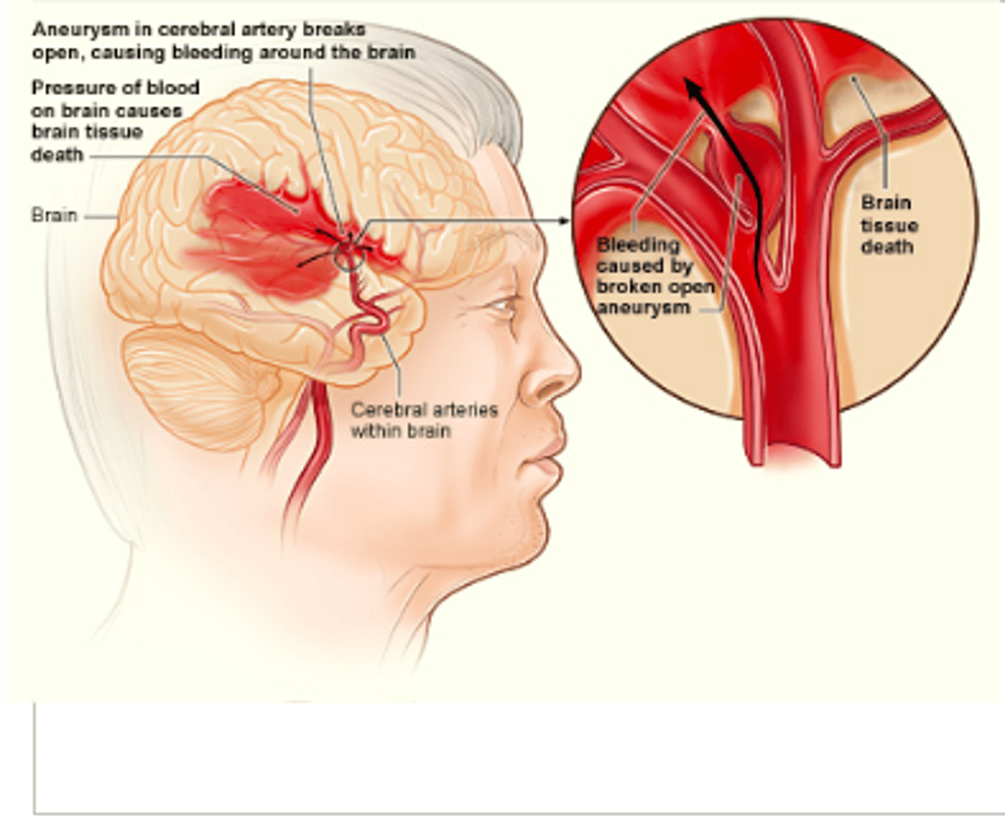 <p>Occurs when blood vessels rupture, causing leakage of blood in or around the brain</p><p>worse prognosis due to a ruptured blood vessel leaks blood into the brain</p>