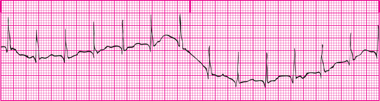<p>Artifact in which the tracing drifts away from the center of the graph paper. Also known as a baseline shift. Occurs when the baseline of the ECG tracing drifts away from the center of the paper.&nbsp;</p>