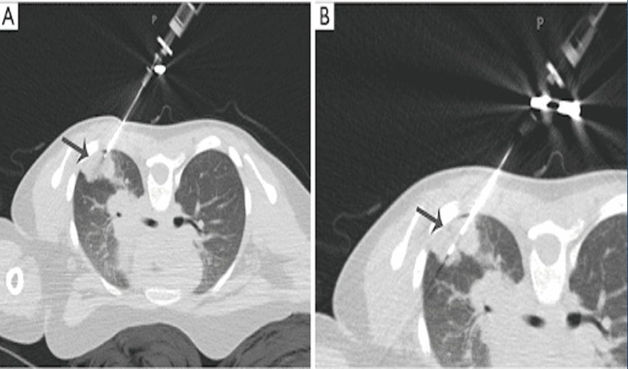 <p>peripheral lesions away from diaphragm</p><p>25% chance of pneumothorax</p><p>benefit for patients who are poor operative candidates</p><p>negative needle biopsy may be a false negative</p>