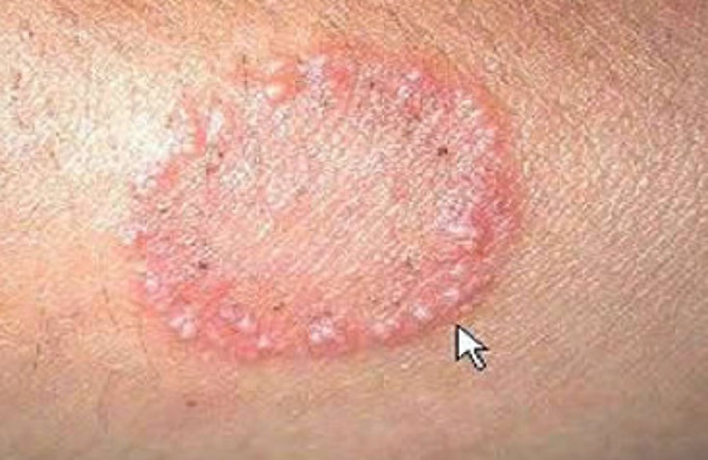 <p>fungal infection of the skin; may infect keratin of the skin, hair, and nails; infections are classified by body regions such as tinea capitis (scalp), tinea corporis (body), and tinea pedis (foot); ringworm; athlete's foot</p>