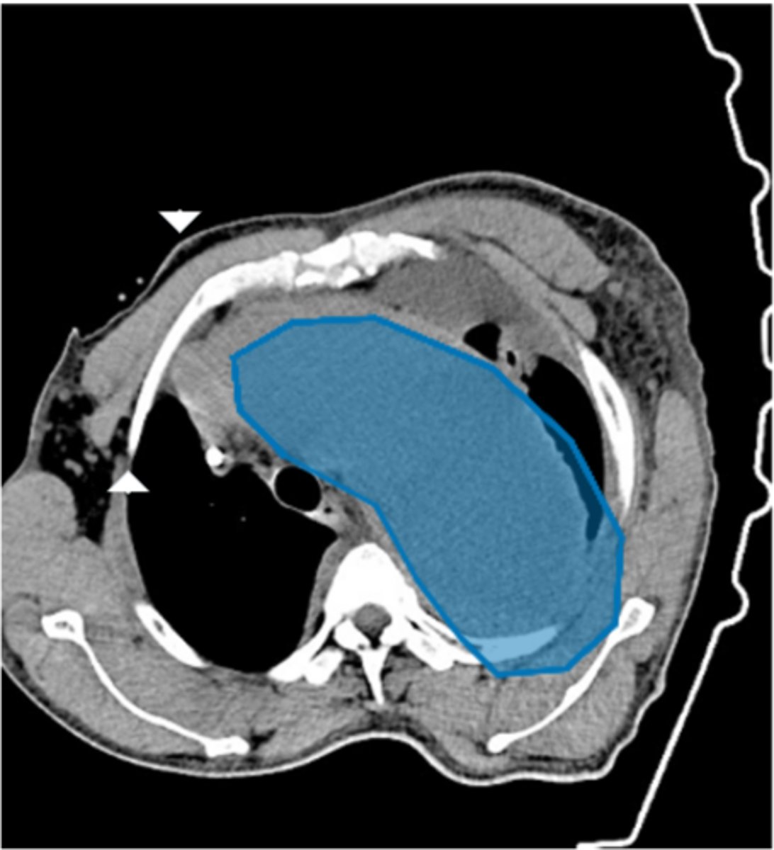 <p>Label the highlighted pathology in the image below</p>