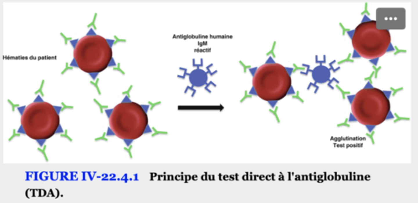 <p>Test direct à l’antiglobuline (TDA, ou Coombs direct)</p><p>Objectif : détecter des anticorps ou du complément déjà fixés in vivo sur les GR du patient.</p><p>Méthode :</p><p>On prend les GR du patient.</p><p>On ajoute un sérum antiglobuline (anti-IgG et/ou anti-C3).</p><p>Si les GR sont couverts d’IgG ou de complément → l’antiglobuline les relie entre eux → agglutination visible.</p><p>Interprétation :</p><p>Positif → présence d’auto-anticorps fixés sur les GR → diagnostic d’AHAI probable.</p>