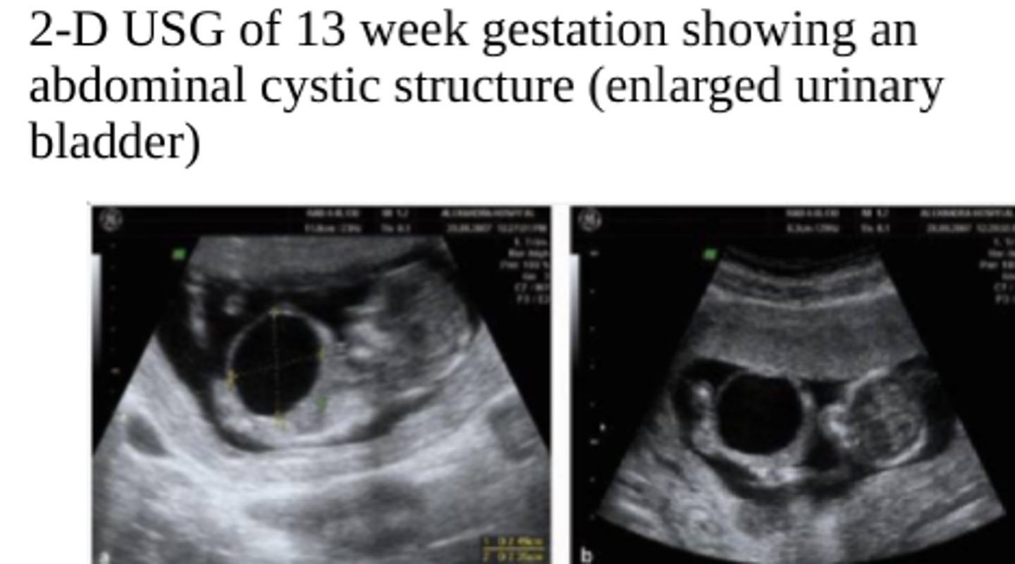 <p>Prune Belly/Eagle-Barrett syndrome</p>