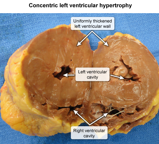 <p>hypertensive heart disease (uniform thickened) </p>