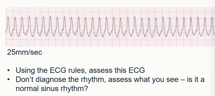 <p>Using ECG rules, assess this ECG</p><ul><li><p>assess what you can see</p></li><li><p>is it normal sinus rhythm</p></li></ul><p></p>