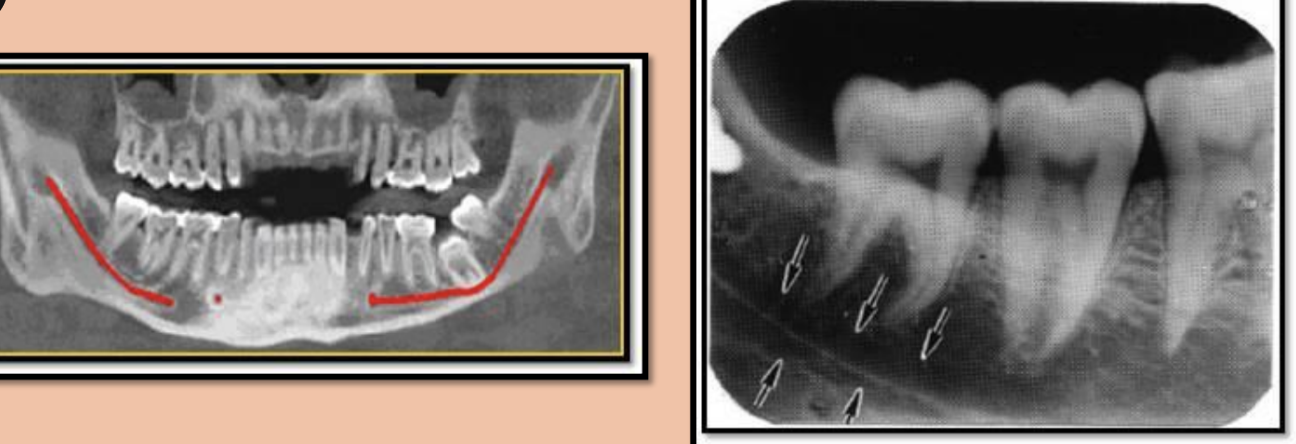 <ul><li><p>Radiolucent </p></li><li><p>Ex. mandibular canal </p></li></ul><p></p>