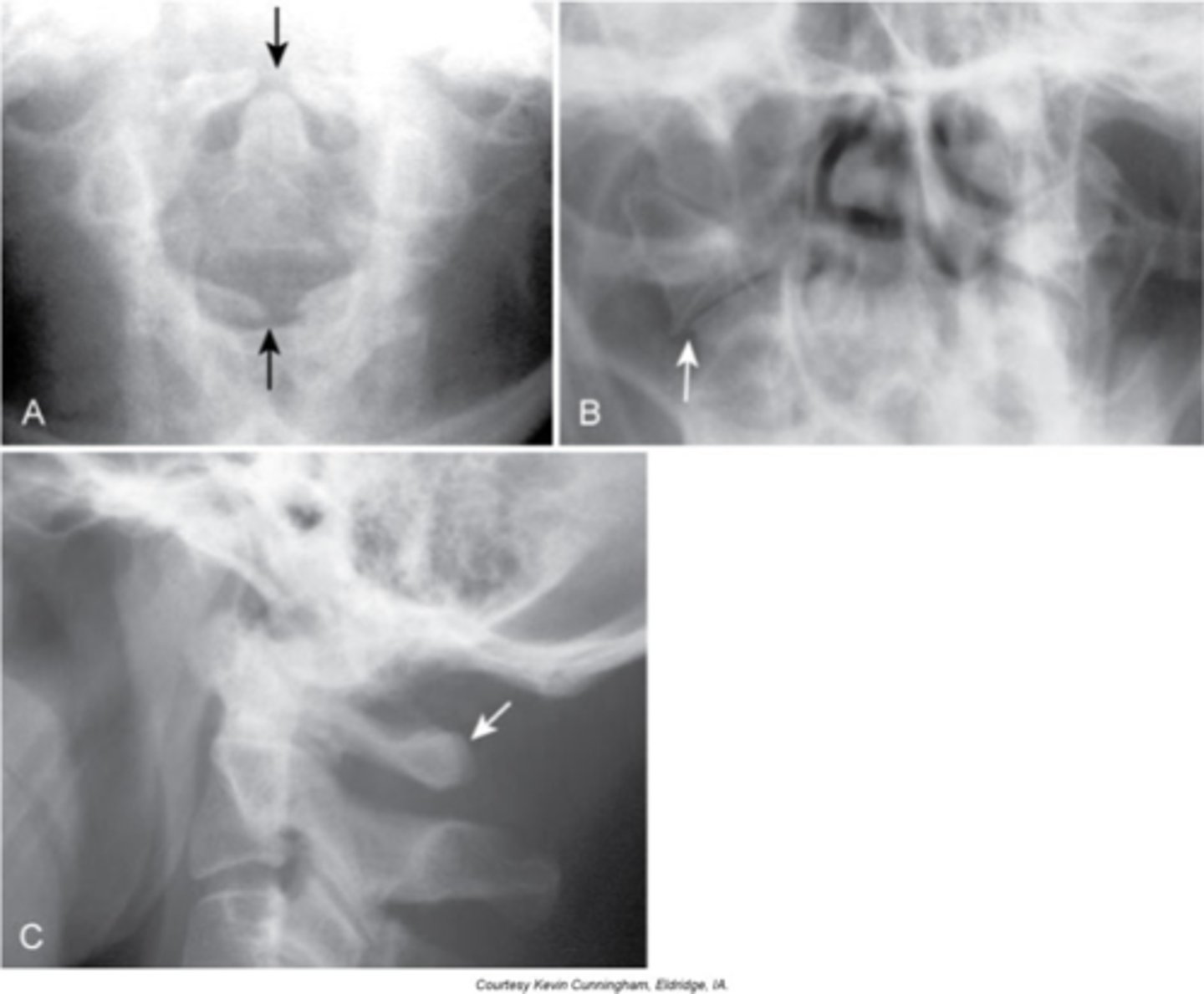 <p>Midline defect (cleft) within the posterior neural arch</p><p>- Fibrocartilaginous bridge between the osseous ends of the bones</p>