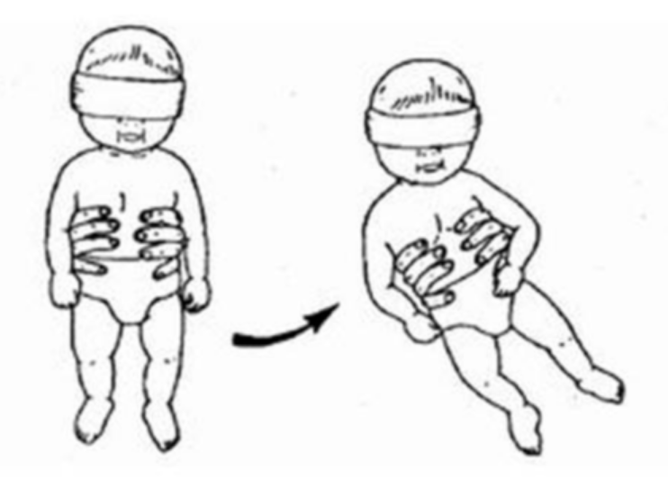 <ul><li><p><strong>stimulus: </strong>hold infant suspended vertically and tilt slowly (45deg) to side forward or backward</p></li><li><p><strong>response: </strong>upright positioning of head</p></li><li><p><strong>fxn sig: </strong></p><ul><li><p>basis for head management and postural stability</p></li><li><p>orients head in space vertically</p></li></ul></li><li><p><strong>onset age: </strong>birth-2mos</p></li></ul><p></p>