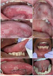 <p>painless slightly raised oval lesion</p><p>covered by grayish membrane</p><p>caused by secondary syphillis</p><p>highly contagious</p>